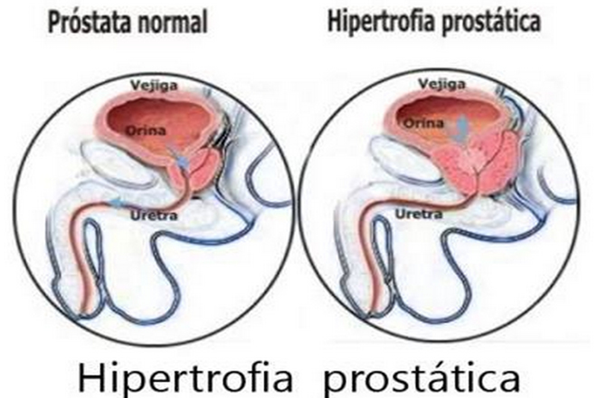 hipertrofia prostatica)