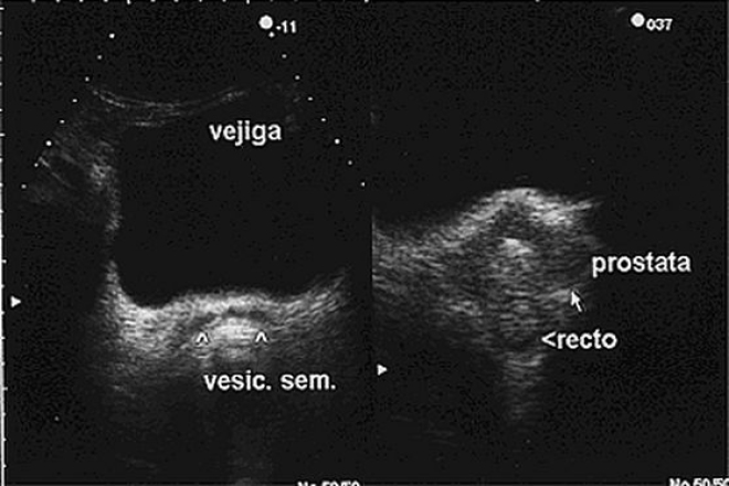 anatomia prostata ecografia decocturi de prostatită congestivă