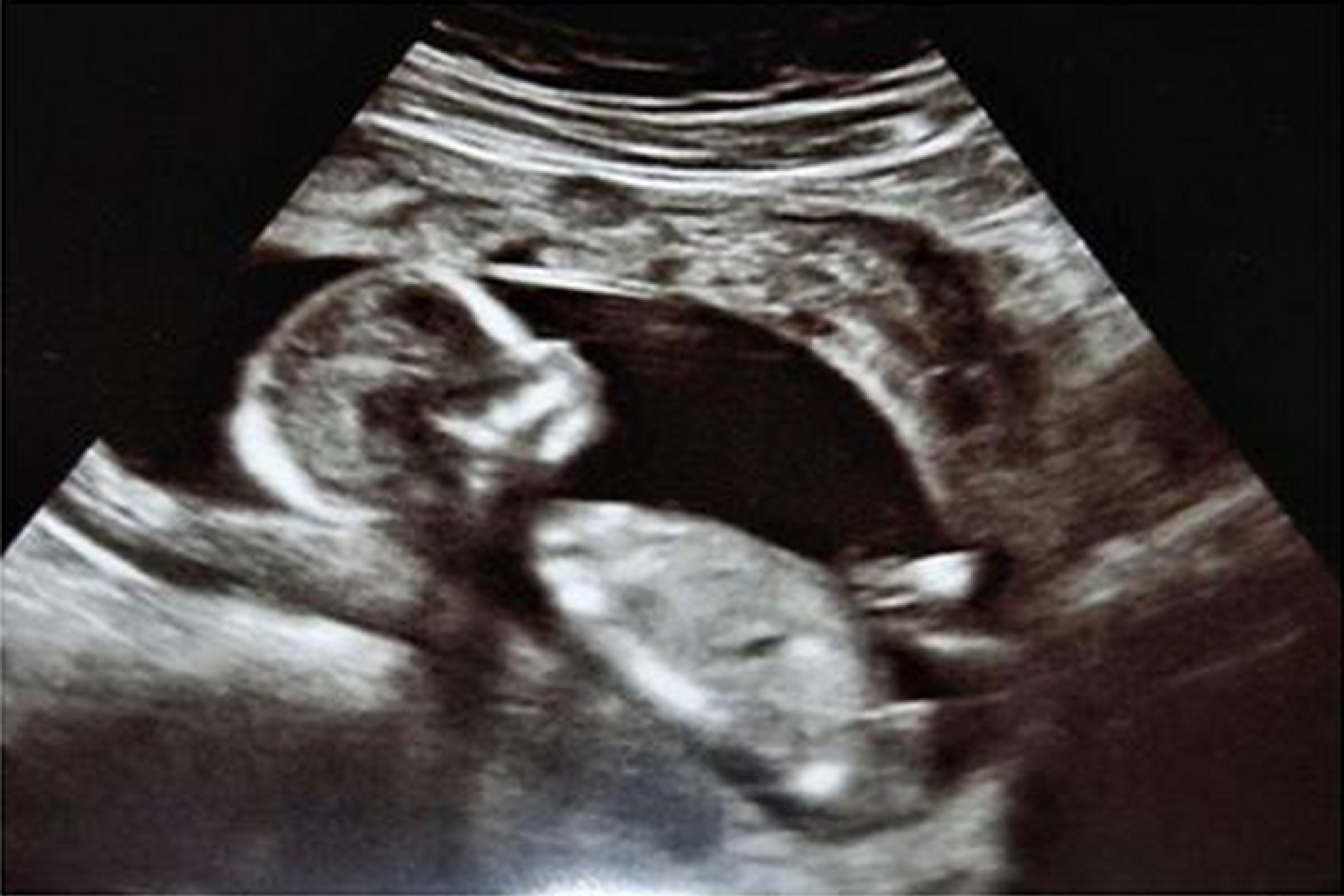 Мальчик 13 недель беременности