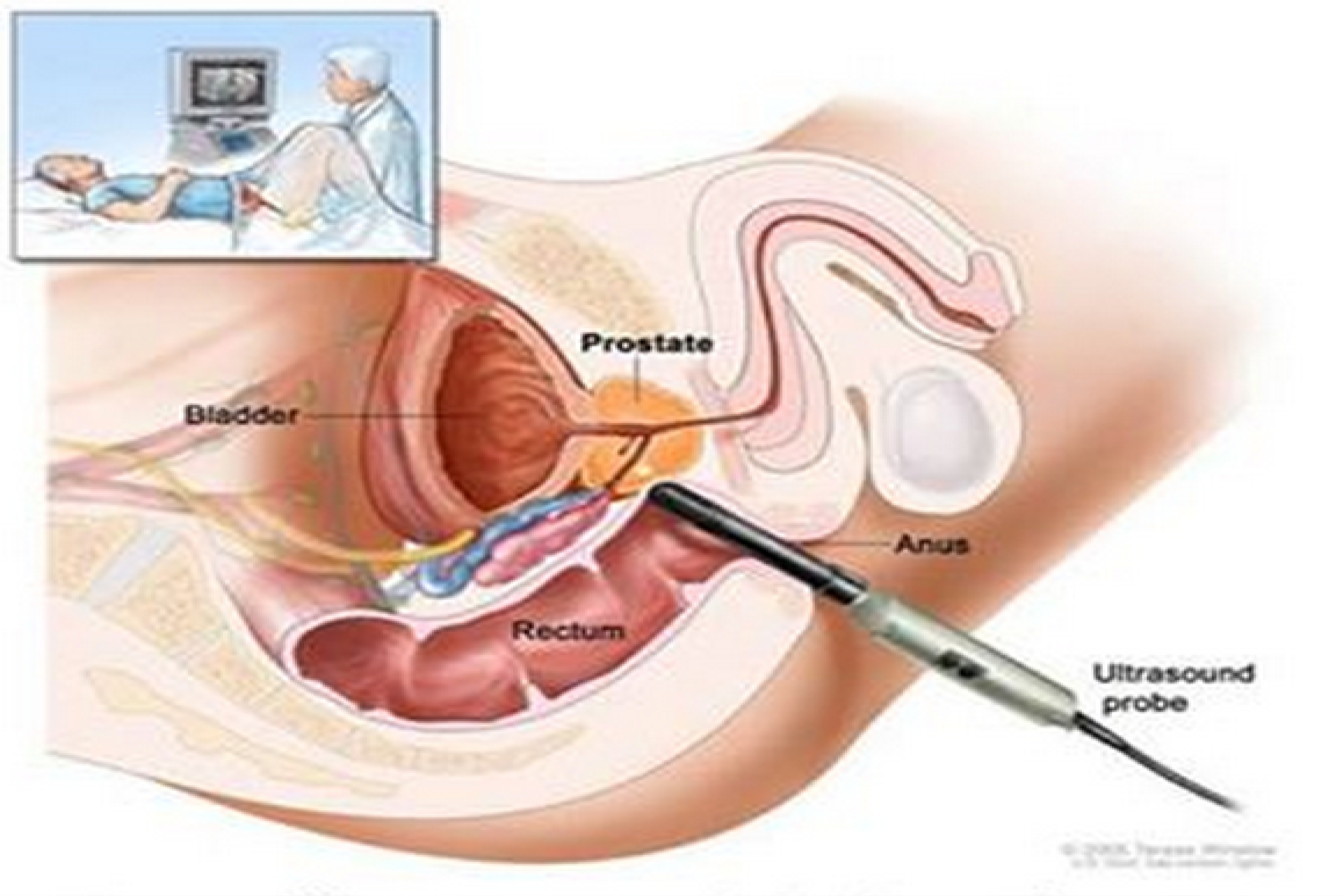 ecografía transrectal de próstata preparación