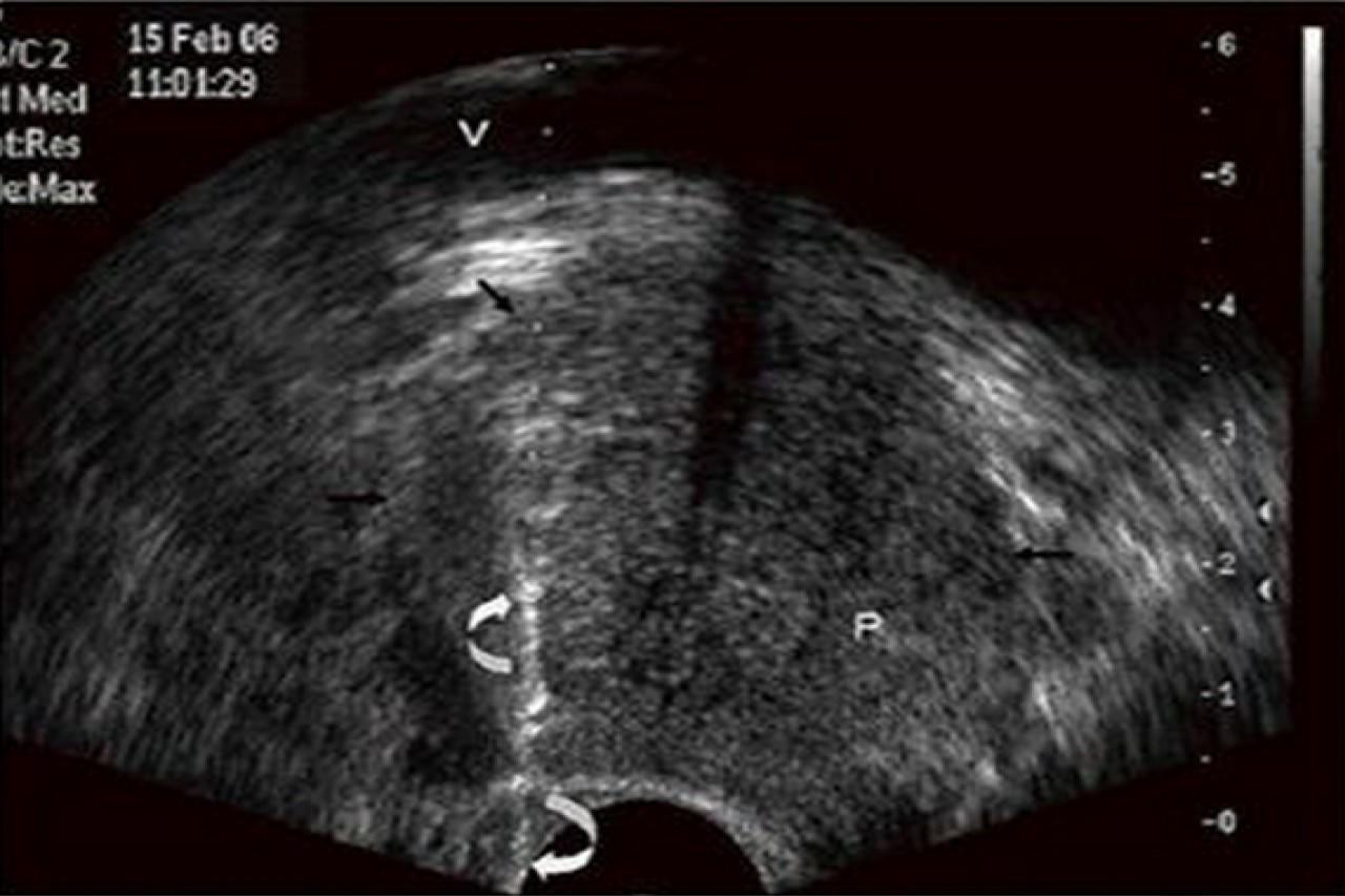 Biopsia transrectal de próstata experiencia en el Hospital Regional