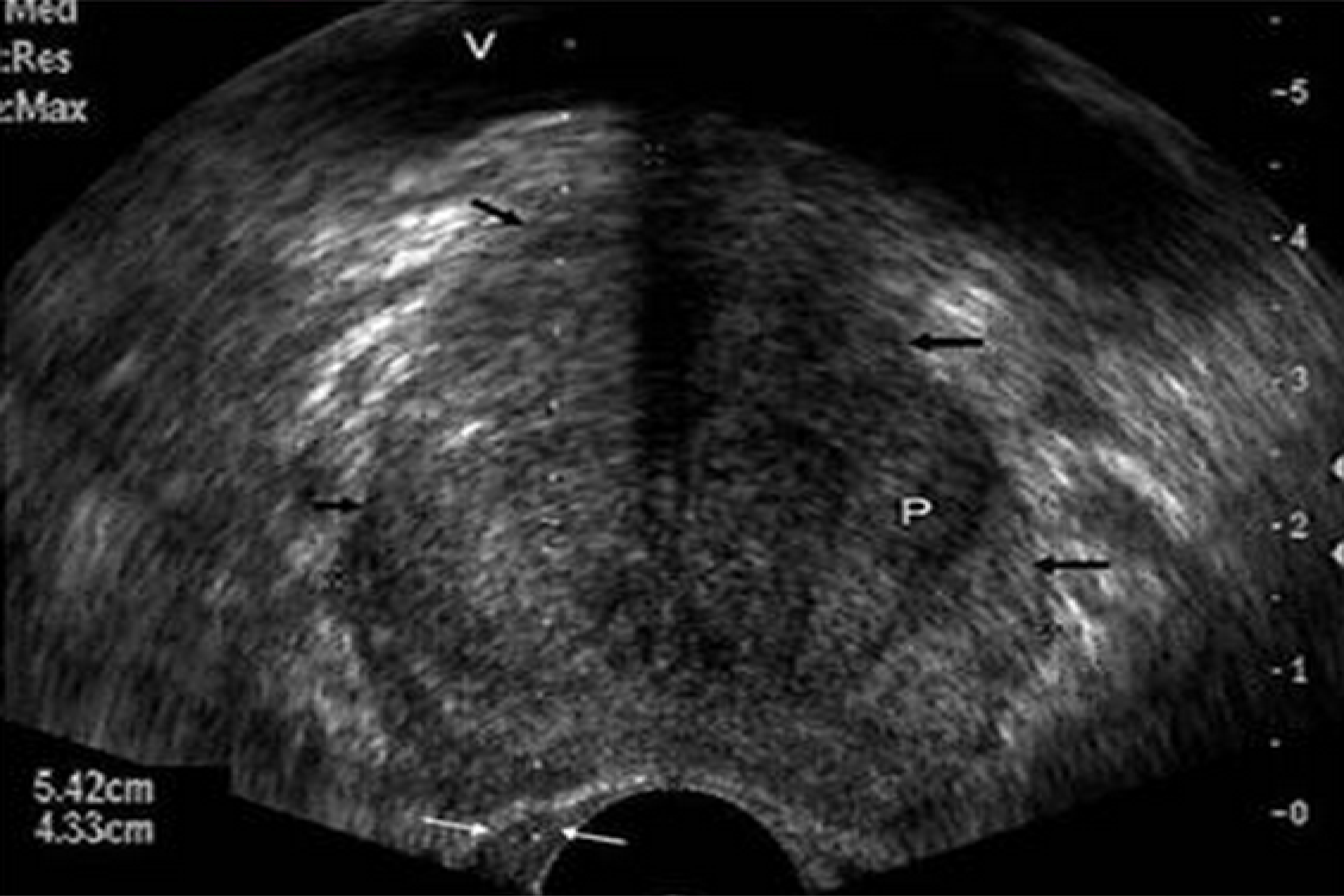 Biopsia de prostată transrectal sub ghidaj ecografic, Cancer de prostata biopsia