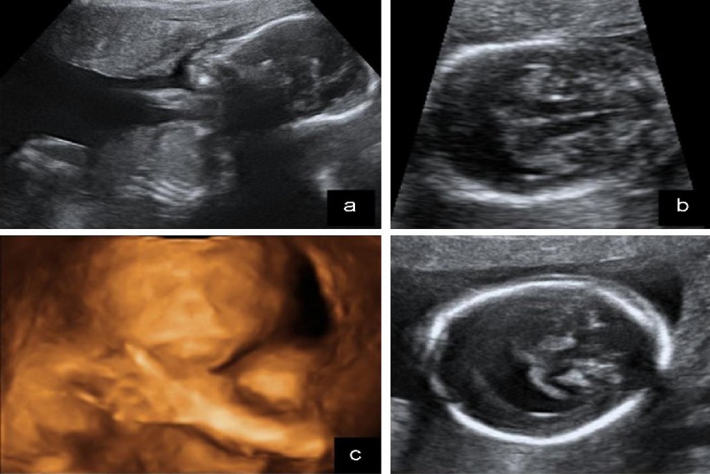 DETECCION PRENATAL DE ANOMALÍAS DEL SISTEMA NERVIOSO CENTRAL