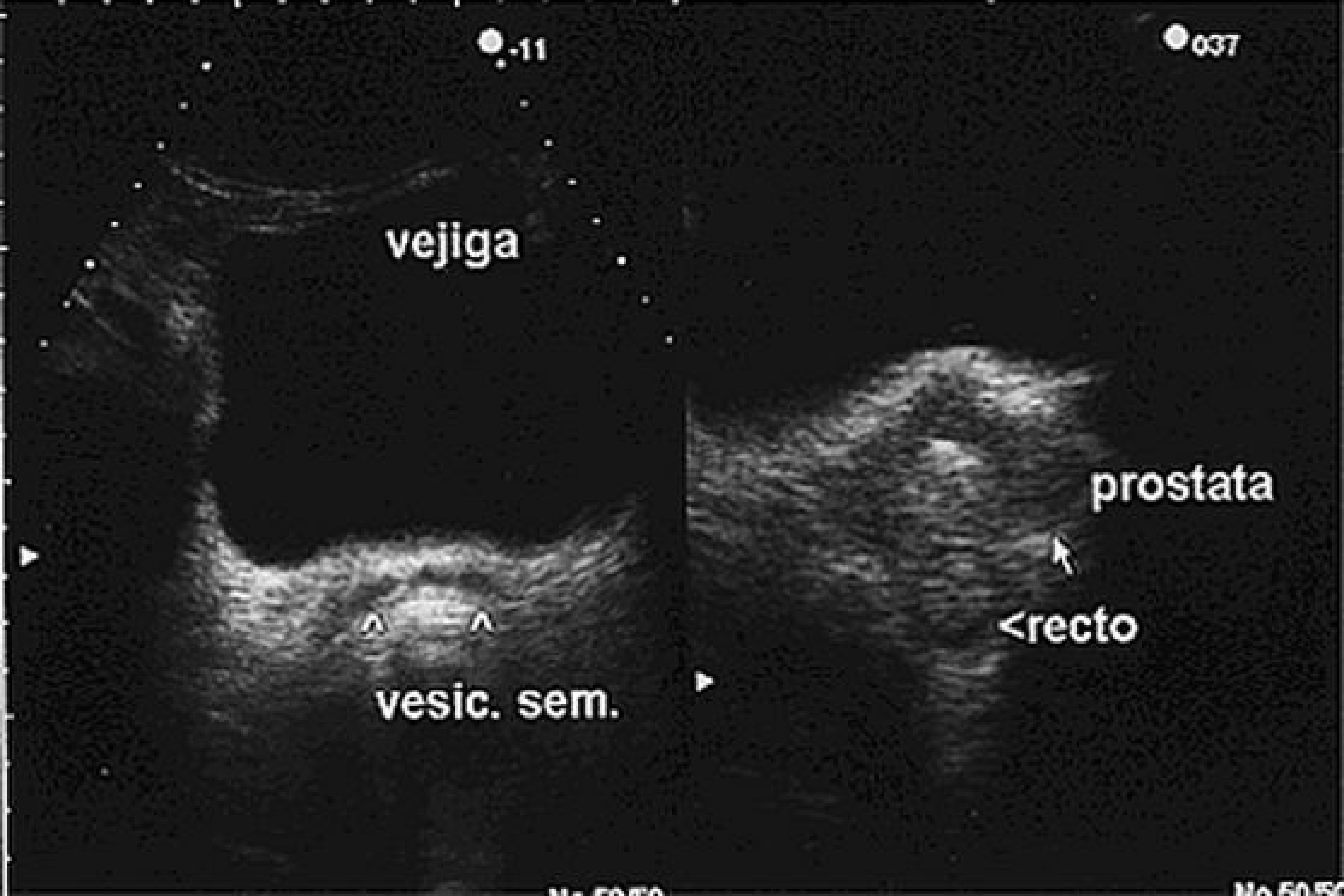 Cancer de prostata ultrassonografia. Cancer testicular seguimiento - Cancer de prostata ultrasonido