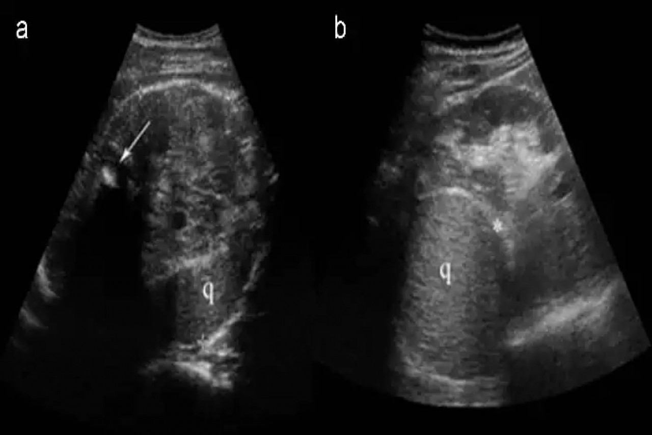 APARIENCIA ULTRASONIDA DE LA ENFERMEDAD CONGÉNITA RENAL