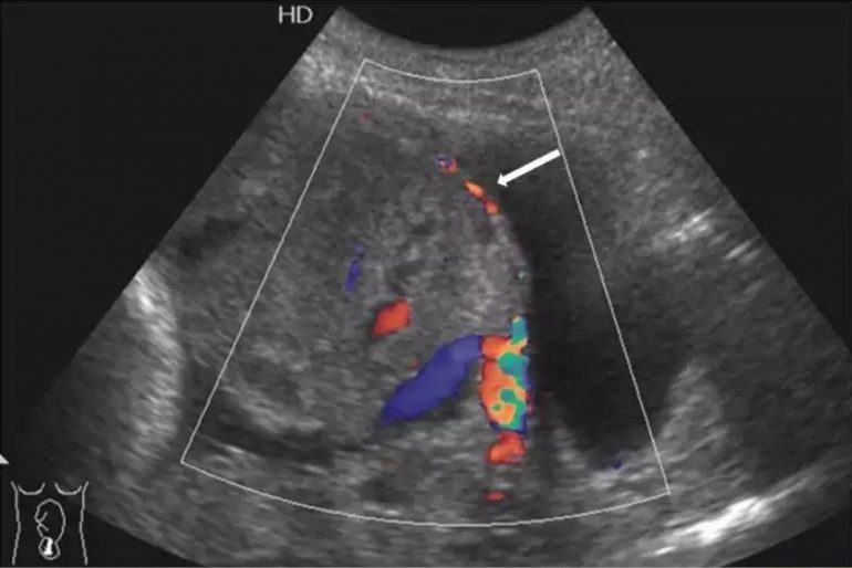 Diagnostico Ultrasonografico De Placenta Accreta 