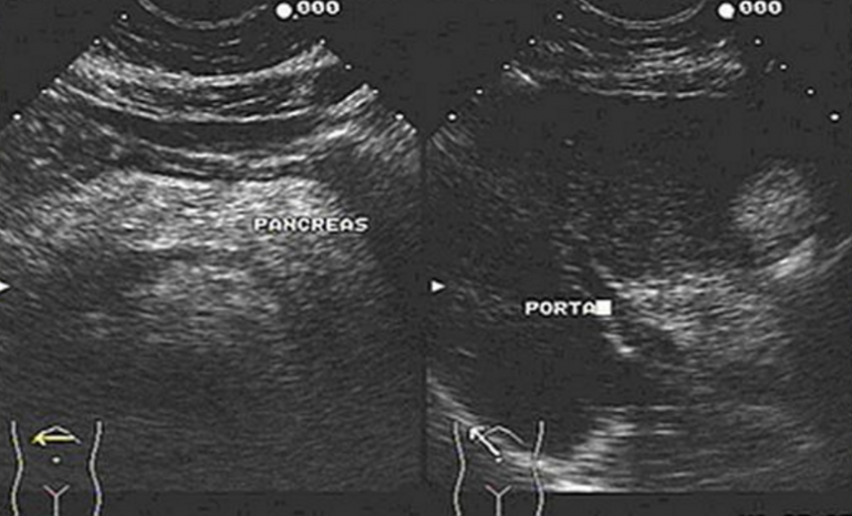 La esteatosis pancreática es una patología cada día más diagnosticada, por la presencia de nuevas y más sofisticadas técnicas de imagen, entre ellas la eco endoscopía, la cual nos permite identificar los mínimos cambios que presenta el parénquima pancreático