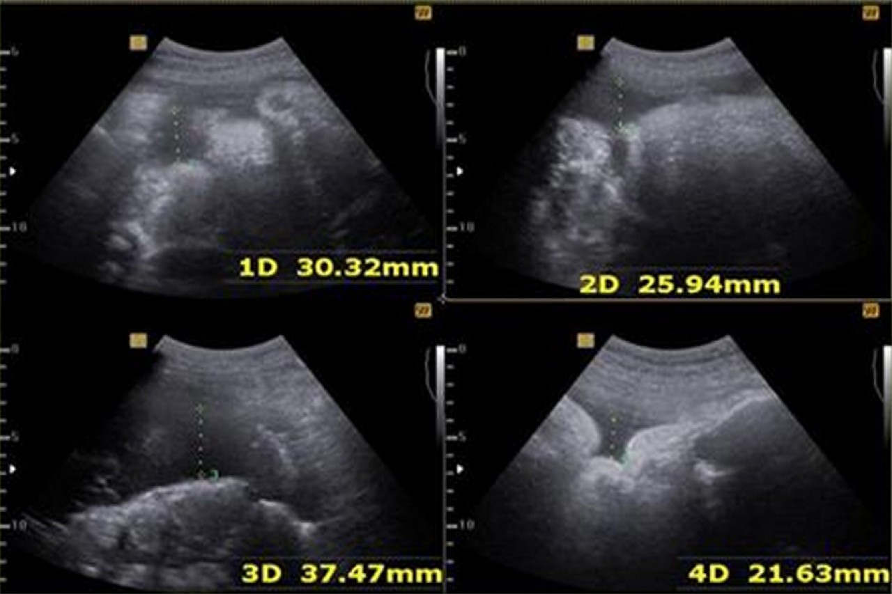 Perfil Biofísico Para Conocer El Bienestar Fetal