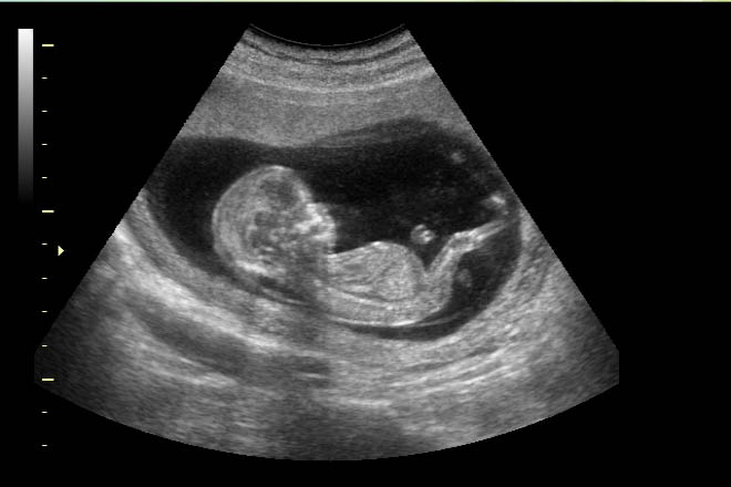 Deteccion Ecografica Y Pronostico De La Ventriculomegalia Fetal Diplomado En Ultrasonido