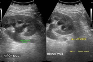 Longitud Renal Por Ultrasonograf A En Poblaci N Mexicana Adulta Diplomadomedico Com