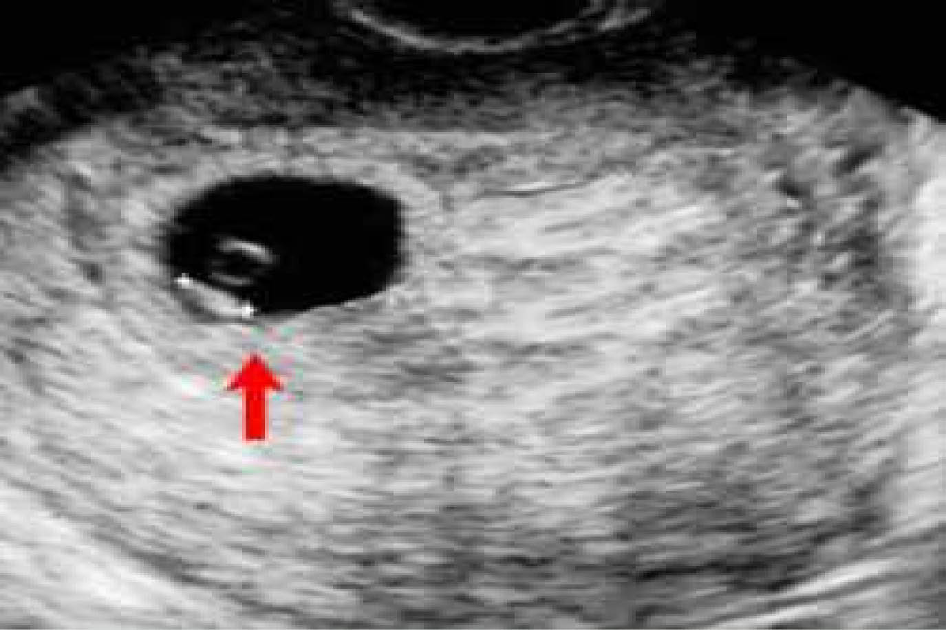 Ultrasonido En El Primer Trimestre Del Embarazo Diplomadomedico Com