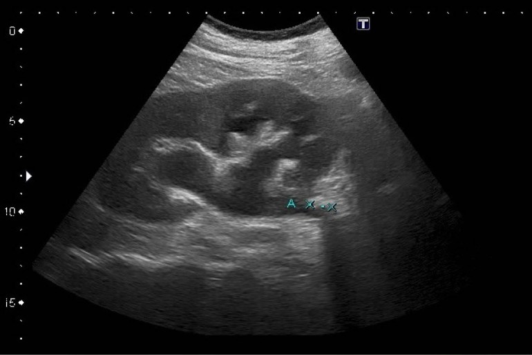 área hipoecoica trastornos de la próstata sistema urinario área hipoecoica trastornos de la próstata sistema urinario