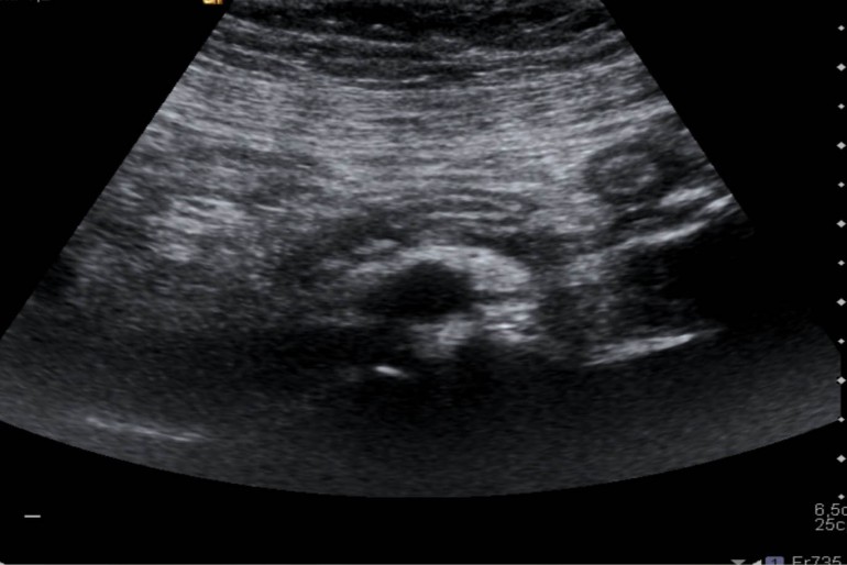 Dolor de apendicitis en el embarazo