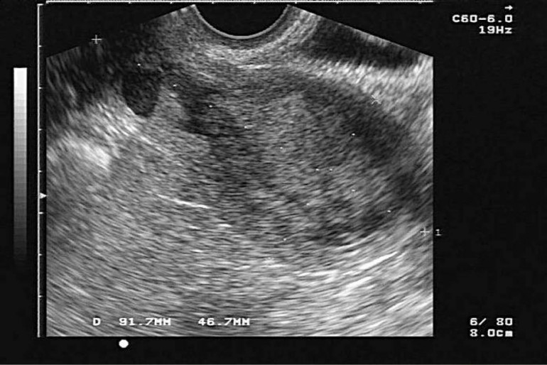 agenesia uterina 2 agenesia uterina 2