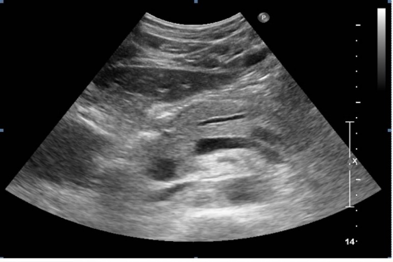 diabetes pancreática atrófica