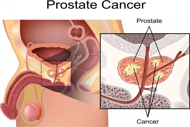 Tratamentul hormonal al cancerului de prostata creste mortalitatea