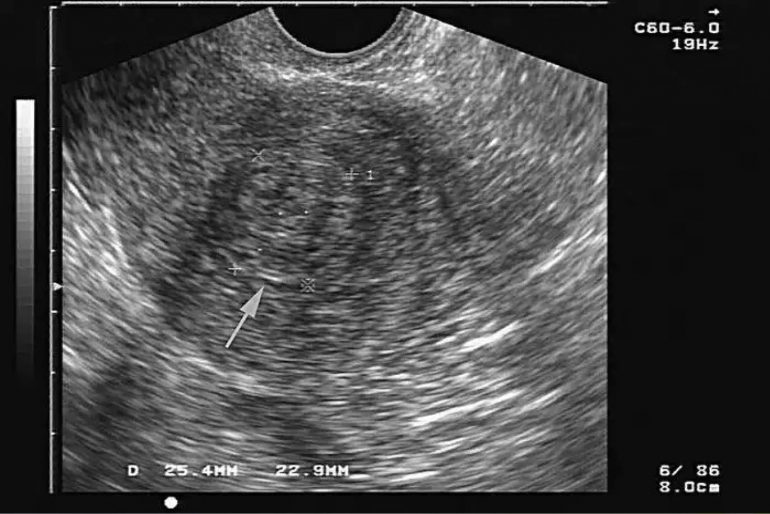 Engrosamiento es del endometrio peligroso el