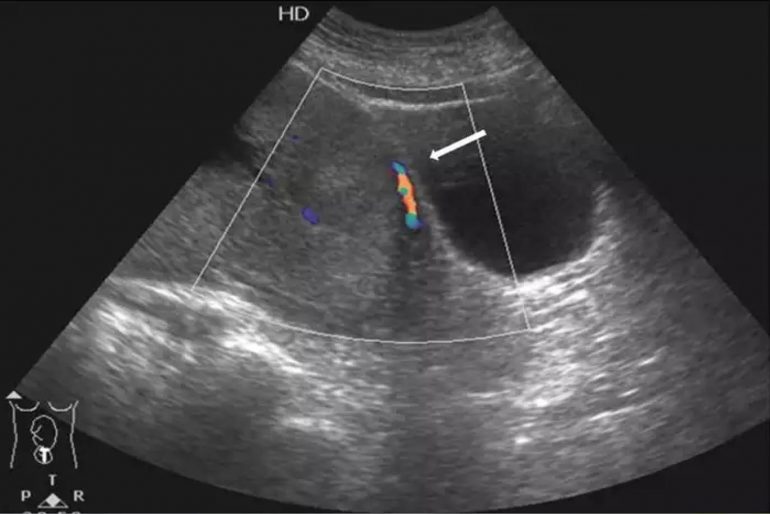 Placenta Previa Clasificacion Ultrasonografica