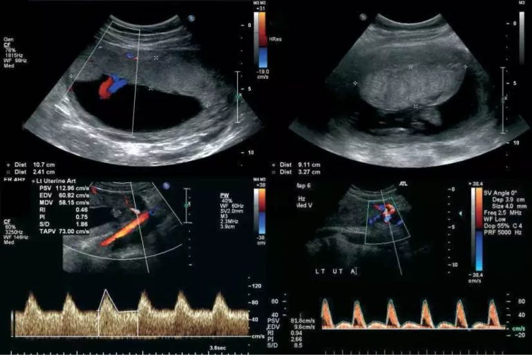 Velocimetría doppler de las arterias uterinas en el embarazo -