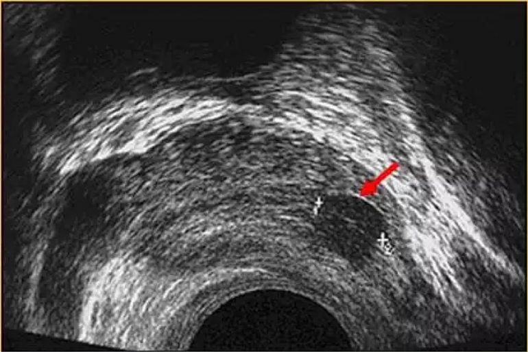 tratamiento del cáncer de próstata con ultrasonido