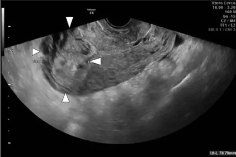 Lecho Placentario amplio sintomático tras aborto del primer trimestre