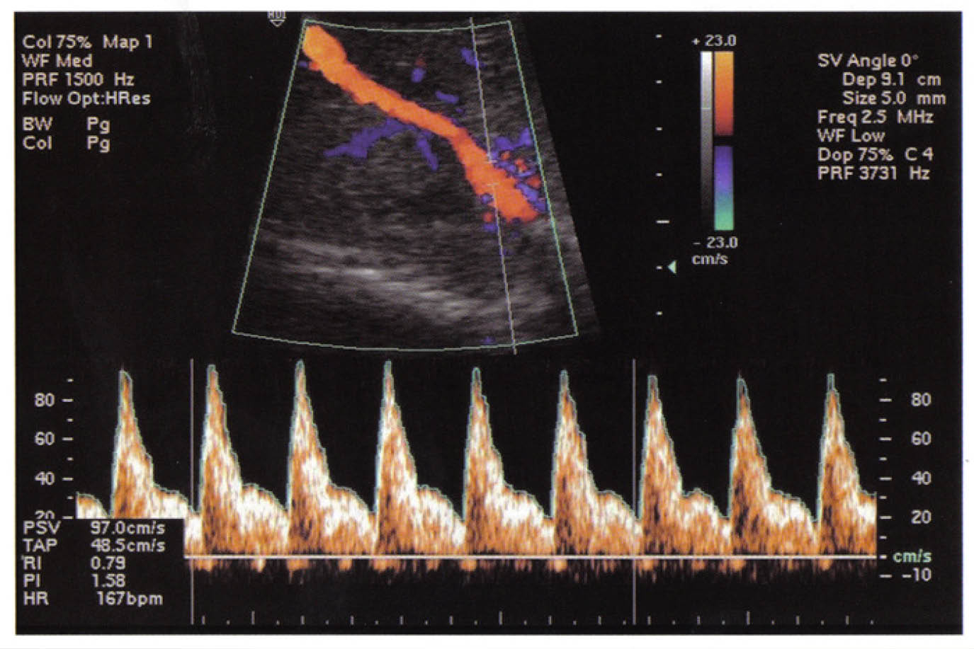 velocimetr-a-doppler-de-las-arterias-uterinas-en-el-embarazo