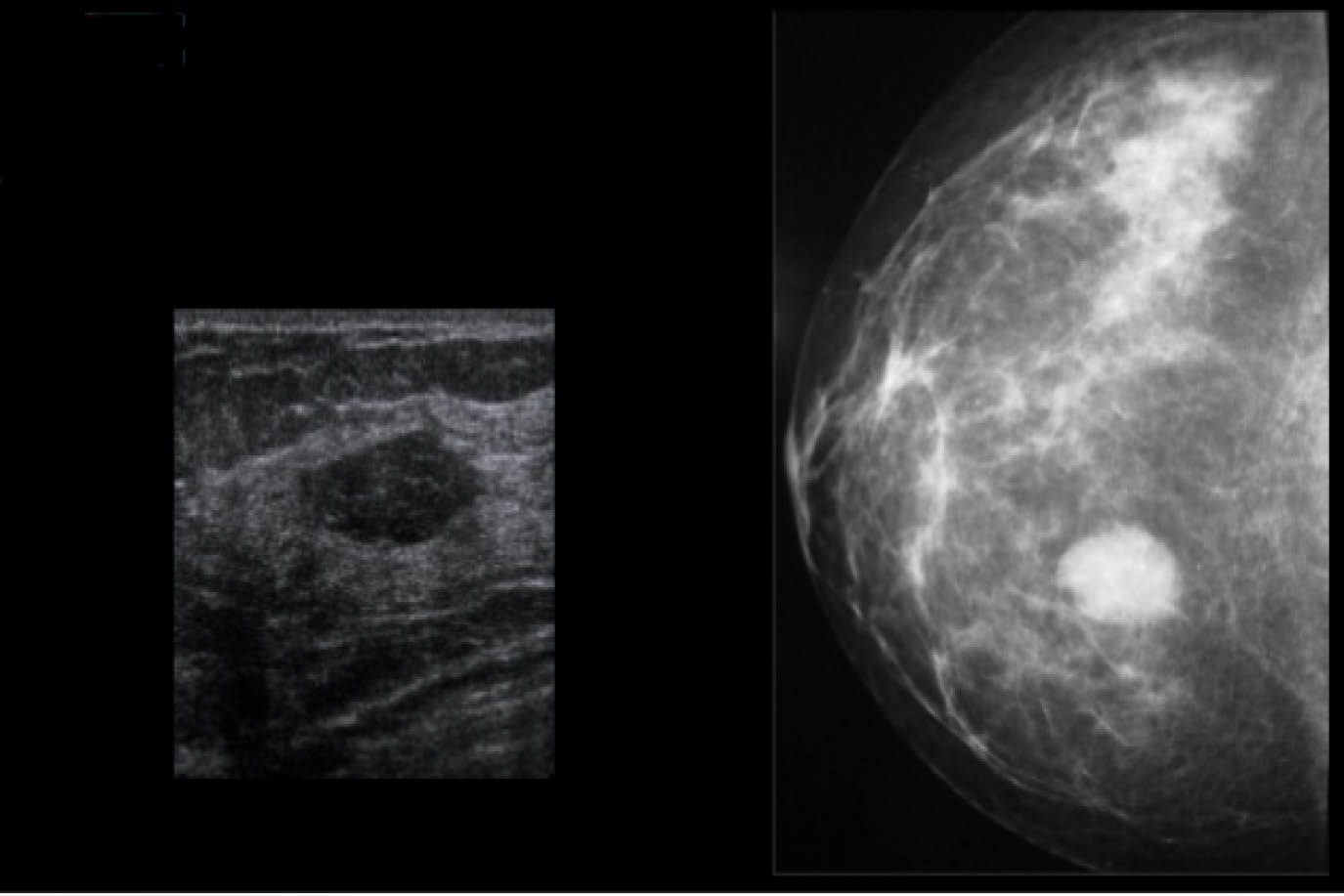 Маммография галактоцеле