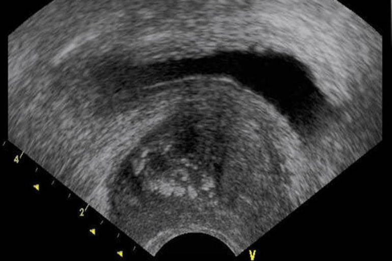 prostatitis crónica diabetes prostatitis crónica diabetes