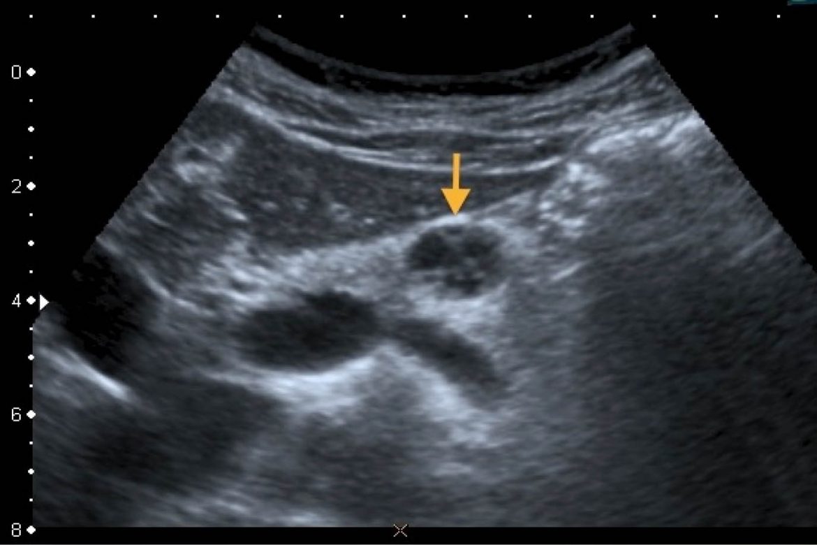 Utilidad del ultrasonido endoscópico en el diagnóstico de pancreatitis