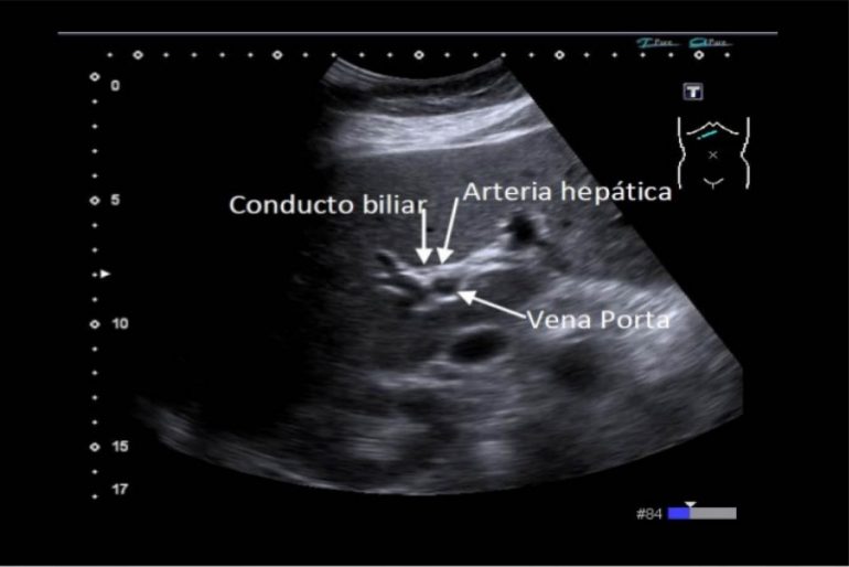 Obstrucción duodenobiliar en el síndrome de peurtz jeghrs