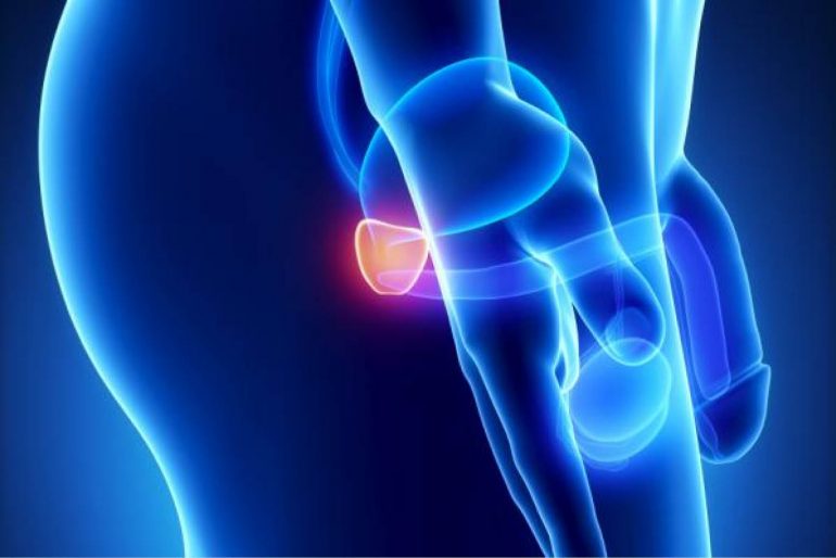 pronóstico de próstata de carcinoma intraductal