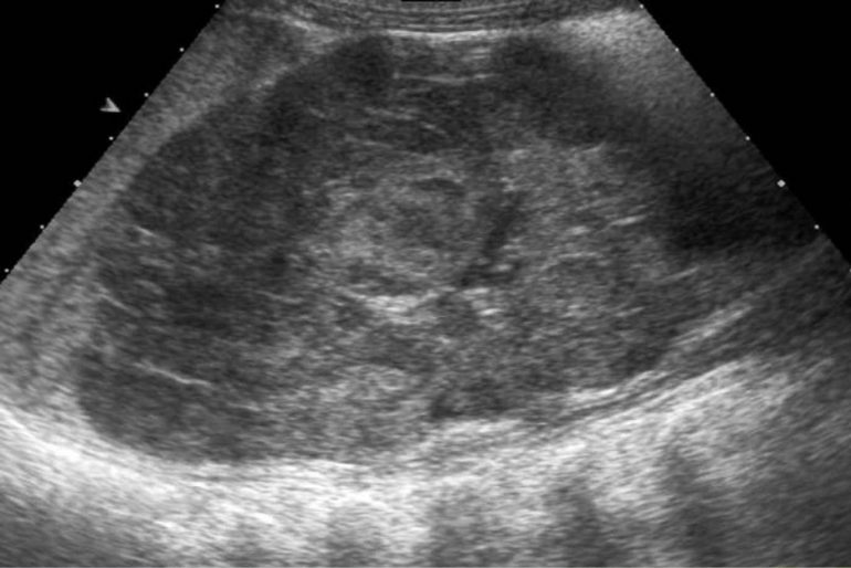 Variaciones en la disposición de las estructuras del hilio renal.
