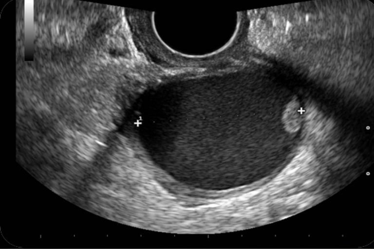 Diagnóstico imagenológico de un teratoma gigante de ovario Diagnóstico imagenológico de un teratoma gigante de ovario