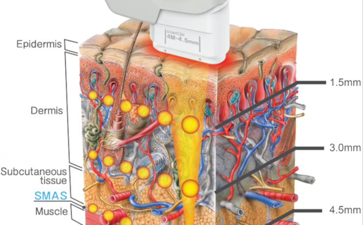 El atractivo del HIFU (High in- tensity focused ultradound) robotizado se basa ampliamente en la naturaleza no invasiva, extremadamente precisa de este tratamiento robótico de alta tecnología, así como su carácter limpio, sin radiación, quirúrgico y sin embargo sin sangrado.