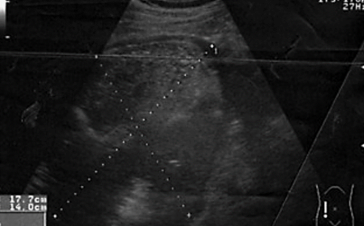 El absceso esplénico se clasifica según las causas en: Infección hematógena metastasica, Sitio contiguo de infección, Hemoglobinopatías, Inmunodeficiencia como el SIDA y trauma abdominal