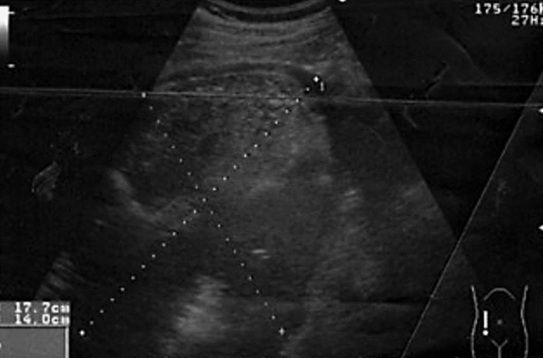 El absceso esplénico se clasifica según las causas en: Infección hematógena metastasica, Sitio contiguo de infección, Hemoglobinopatías, Inmunodeficiencia como el SIDA y trauma abdominal