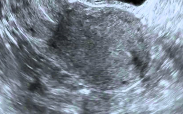 Los leiomiomas uterinos (miomas) son los tumores más comunes encontrados en la mujer. Constituyen neoplasias sólidas benignas muy frecuentes que se desarrollan entre 20 y 50 % durante las edades reproductivas, aunque también se han notificado antes de la pubertad y después de la menopausia. La realización de este trabajo contribuirá a demostrar la importancia de dicho examen para el diagnóstico precoz de esta enfermedad, la prevención de sus complicaciones