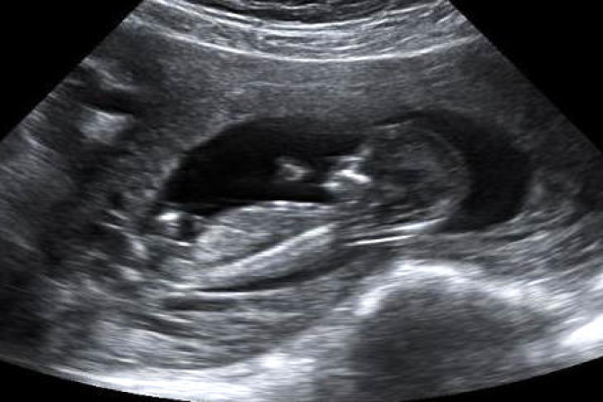 La importancia de la ecografía a las 11+0 a 13+6 semanas de embarazo - Como Se Mide El Peso Del Bebe En Una Ecografia