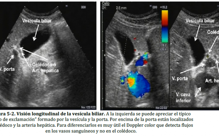 Para la exploración de la vesícula utilizaremos una sonda convexa de baja frecuencia (2,5--‐5 MHz). No hay normas claramente establecidas para localizar la vesícula ya que, como hemos comentado anteriormente su ubicación es variable y su tamaño también puede modificarse (mayor en ayunas que en periodo postprandial debido a tener un mayor contenido de bilis).
