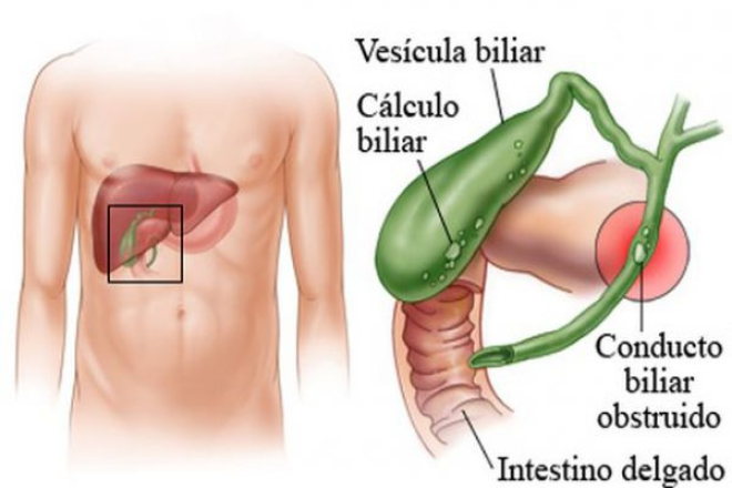 Cetosis vesícula biliar