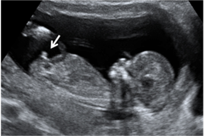Diagnostico Ultrasonografico De Sexo Fetal 7291