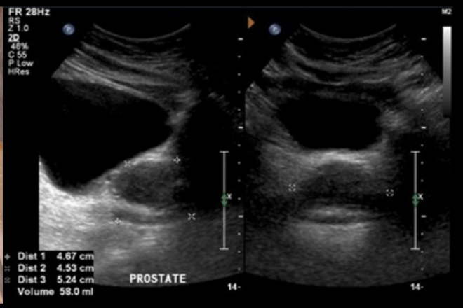 Examinarea RM multiparametrica a prostatei | Spitalul Monza - Cancer de prostata biopsia