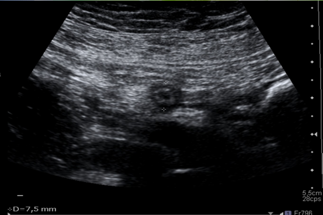 criterios ultrasonográficos de apendicitis