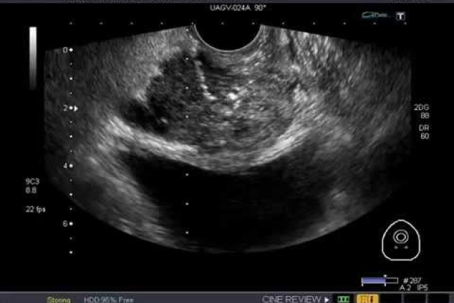 adenoma de próstata grado 2 español adenoma de próstata grado 2 español