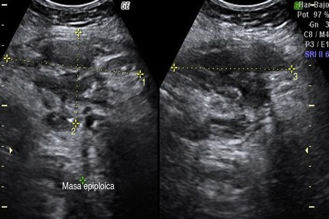 capas anatómicas de la pared abdominal