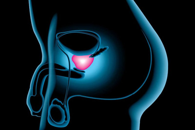 prostatitis crónica y cáncer