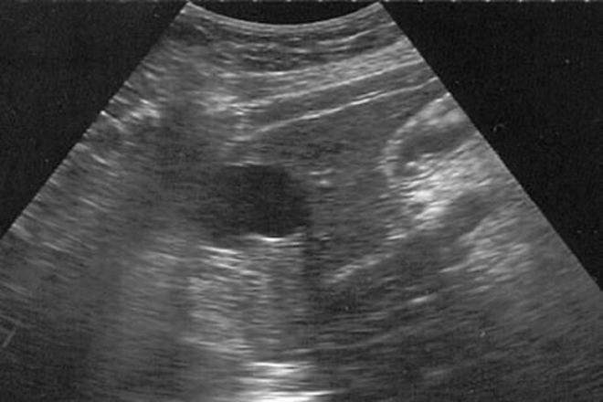 Sintomas quiste hepatico