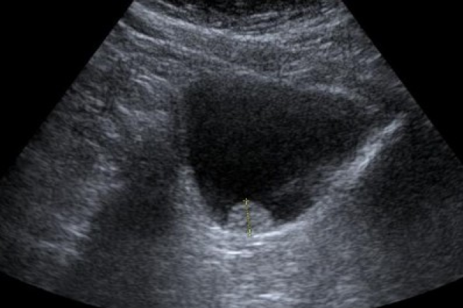 focos de atrofia la prostata
