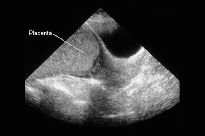 Posterior Placenta Ultrasound