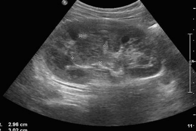 Ectopia renal simple